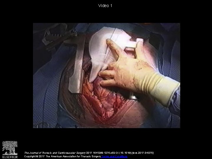 Video 1 The Journal of Thoracic and Cardiovascular Surgery 2017 1541269 -1275. e 5
