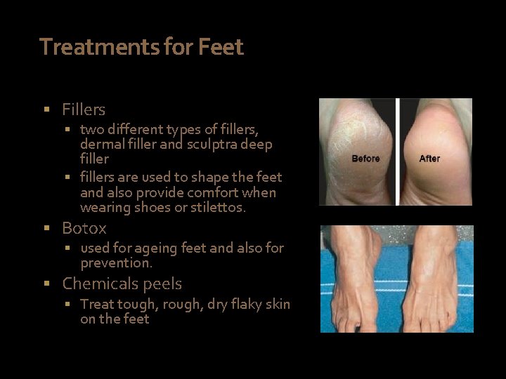 Treatments for Feet § Fillers § two different types of fillers, dermal filler and