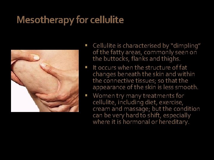 Mesotherapy for cellulite § Cellulite is characterised by “dimpling” of the fatty areas, commonly
