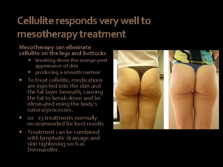Cellulite responds very well to mesotherapy treatment Mesotherapy can eliminate cellulite on the legs