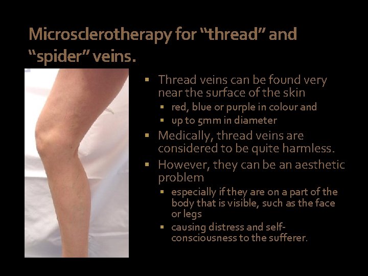 Microsclerotherapy for “thread” and “spider” veins. § Thread veins can be found very near