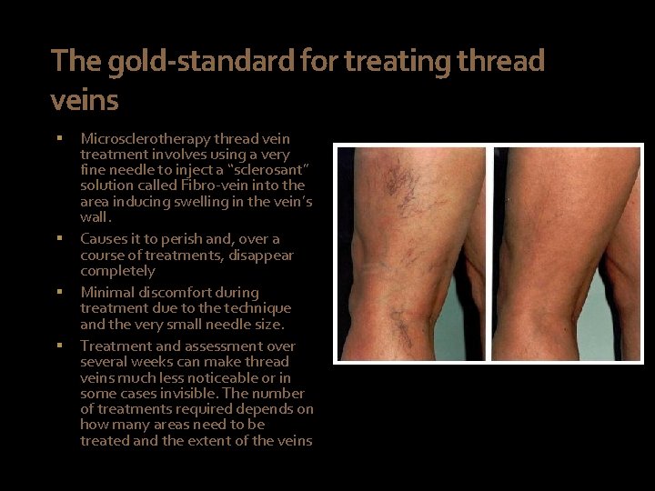 The gold-standard for treating thread veins § § Microsclerotherapy thread vein treatment involves using