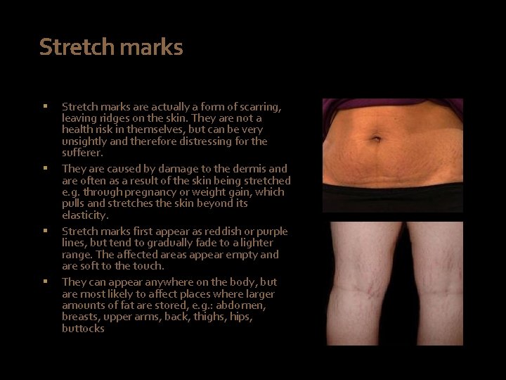 Stretch marks § § Stretch marks are actually a form of scarring, leaving ridges