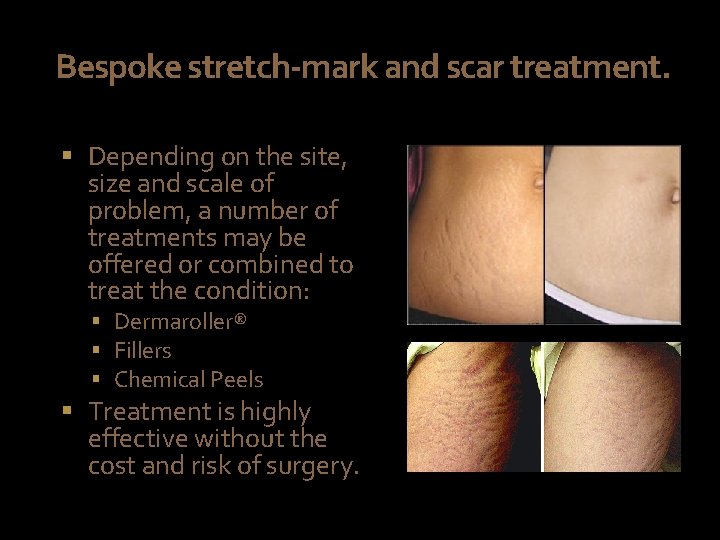 Bespoke stretch-mark and scar treatment. § Depending on the site, size and scale of