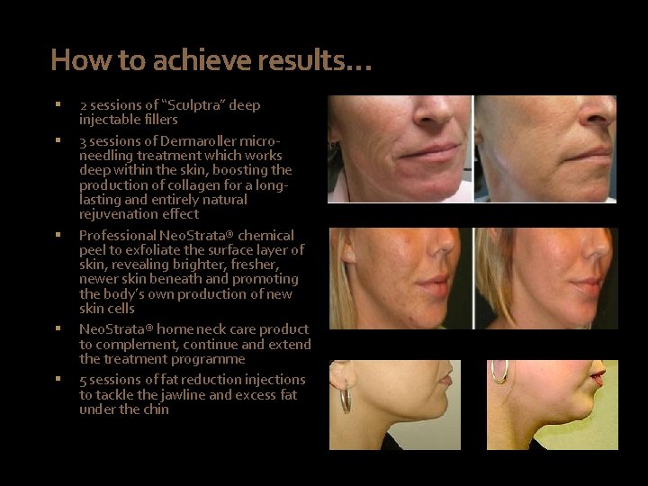 How to achieve results… § § § 2 sessions of “Sculptra” deep injectable fillers