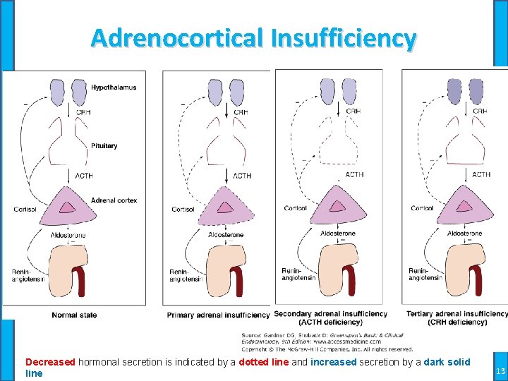 Adrenocortical Insufficiency Decreased hormonal secretion is indicated by a dotted line and increased secretion