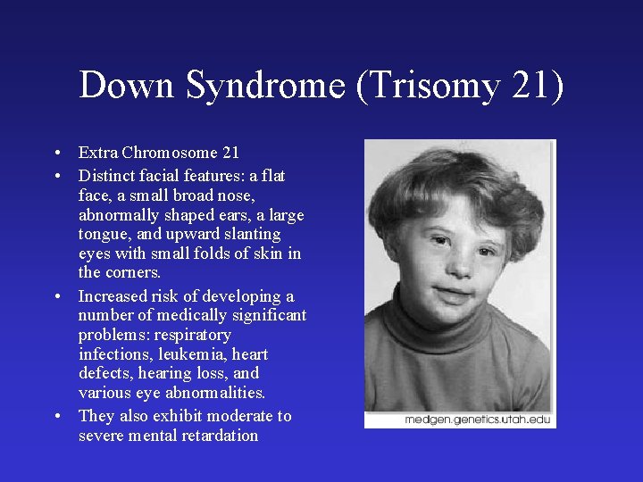 Down Syndrome (Trisomy 21) • Extra Chromosome 21 • Distinct facial features: a flat Down Syndrome (Trisomy 21) • Extra Chromosome 21 • Distinct facial features: a flat