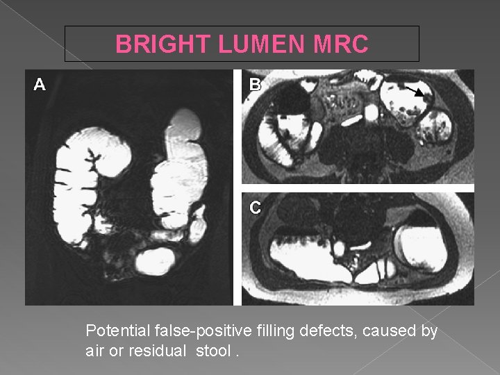 BRIGHT LUMEN MRC Potential false-positive filling defects, caused by air or residual stool. 