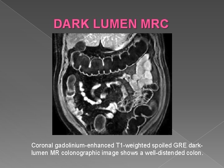 DARK LUMEN MRC Coronal gadolinium-enhanced T 1 -weighted spoiled GRE darklumen MR colonographic image