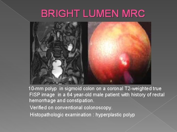 BRIGHT LUMEN MRC 10 -mm polyp in sigmoid colon on a coronal T 2
