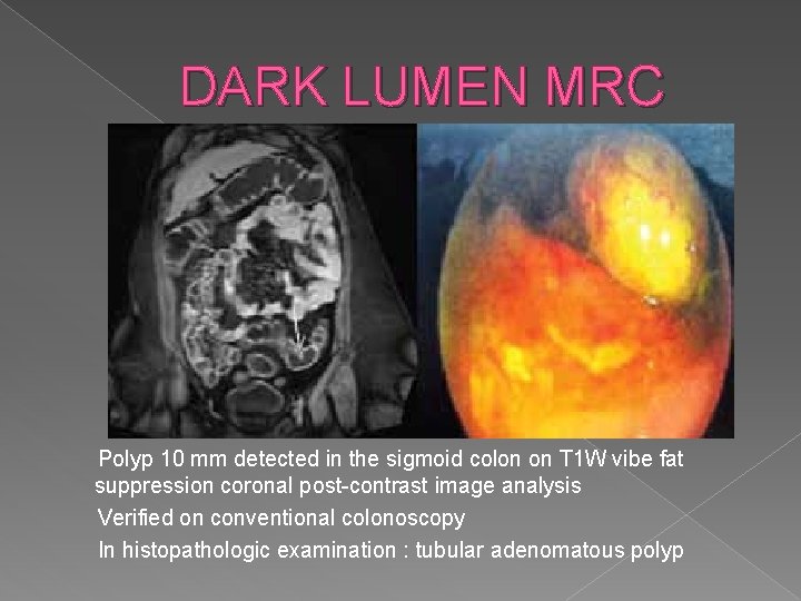 DARK LUMEN MRC Polyp 10 mm detected in the sigmoid colon on T 1