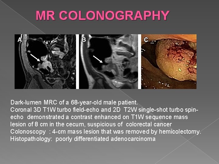 MR COLONOGRAPHY Dark-lumen MRC of a 68 -year-old male patient. Coronal 3 D T