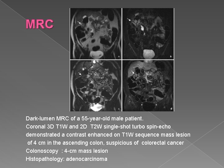 MRC Dark-lumen MRC of a 55 -year-old male patient. Coronal 3 D T 1