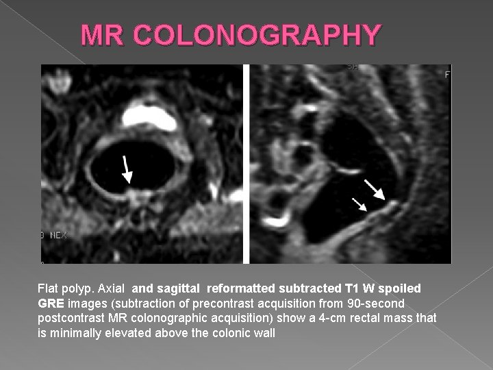 MR COLONOGRAPHY Flat polyp. Axial and sagittal reformatted subtracted T 1 W spoiled GRE