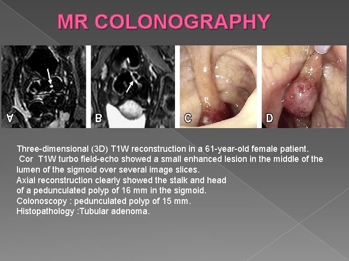 MR COLONOGRAPHY Three-dimensional (3 D) T 1 W reconstruction in a 61 -year-old female