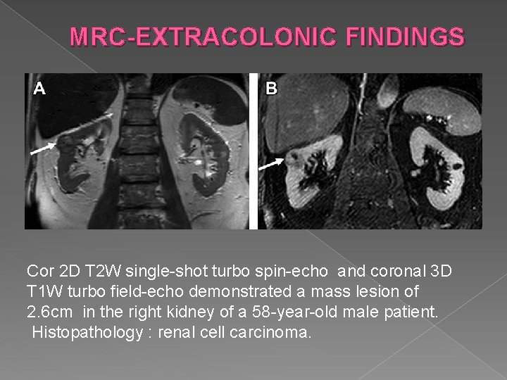 MRC-EXTRACOLONIC FINDINGS Cor 2 D T 2 W single-shot turbo spin-echo and coronal 3