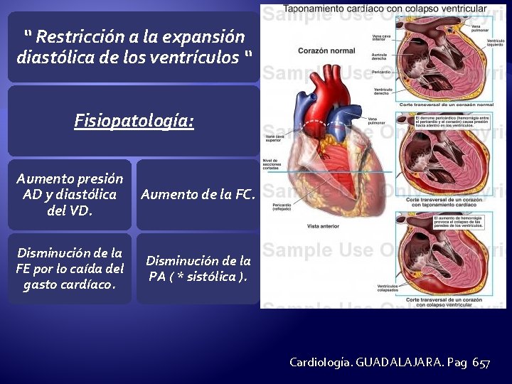 “ Restricción a la expansión diastólica de los ventrículos “ Fisiopatología: Aumento presión AD