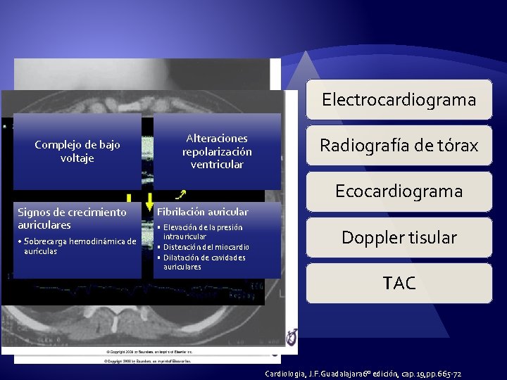 Electrocardiograma Complejo de bajo voltaje Alteraciones repolarización ventricular Radiografía de tórax Ecocardiograma Signos de