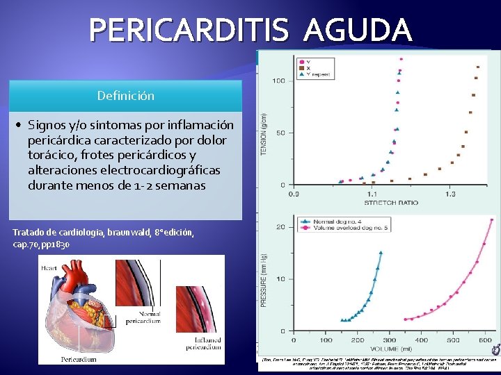 PERICARDITIS AGUDA Idiopática: Definición • Signos y/o síntomas por inflamación pericárdica caracterizado por dolor