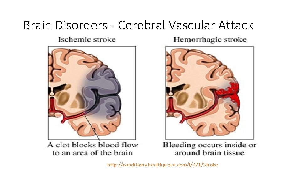 Brain Disorders - Cerebral Vascular Attack http: //conditions. healthgrove. com/l/971/Stroke Brain Disorders - Cerebral Vascular Attack http: //conditions. healthgrove. com/l/971/Stroke