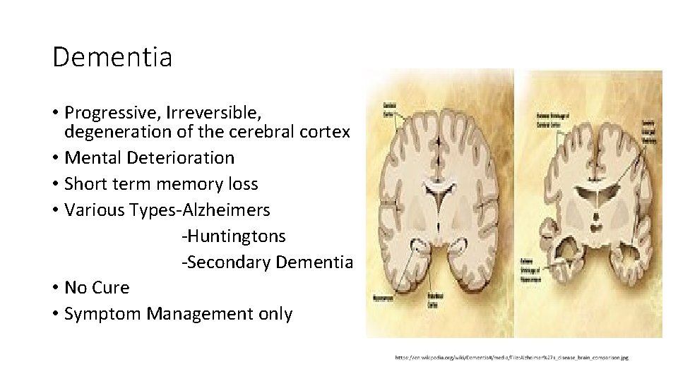Dementia • Progressive, Irreversible, degeneration of the cerebral cortex • Mental Deterioration • Short Dementia • Progressive, Irreversible, degeneration of the cerebral cortex • Mental Deterioration • Short