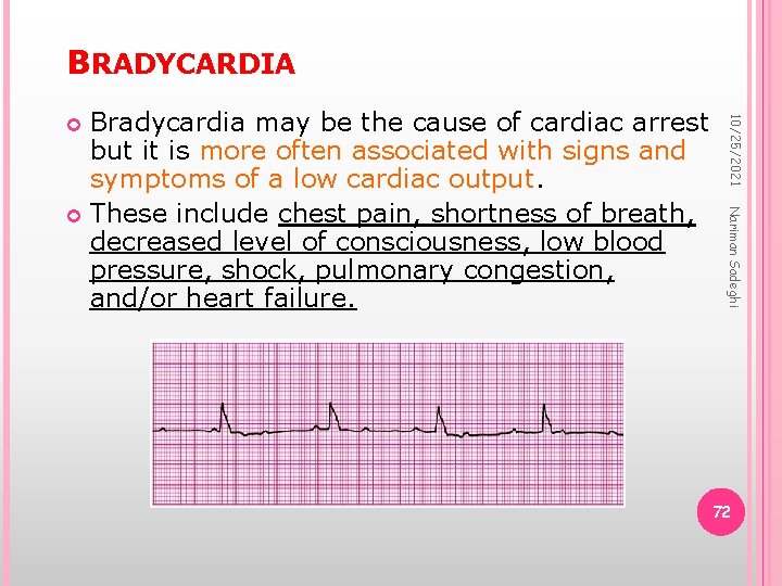 BRADYCARDIA 10/25/2021 Nariman Sadeghi Bradycardia may be the cause of cardiac arrest but it