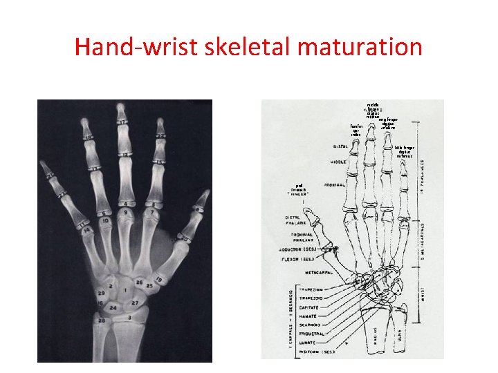 Hand-wrist skeletal maturation forefin ger index middle finger digitus medius ring finger digitus anularis
