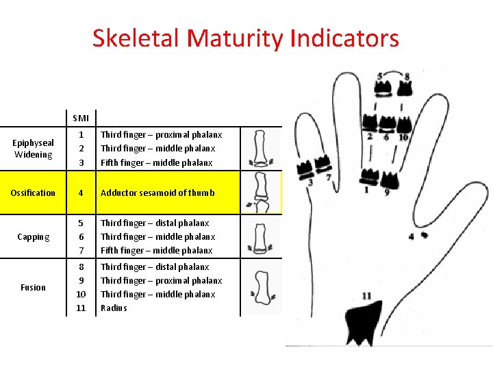 Skeletal Maturity Indicators SMI Epiphyseal Widening 1 2 3 Third finger – proximal phalanx
