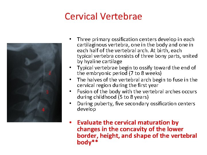Cervical Vertebrae 2 3 4 • Three primary ossification centers develop in each cartilaginous