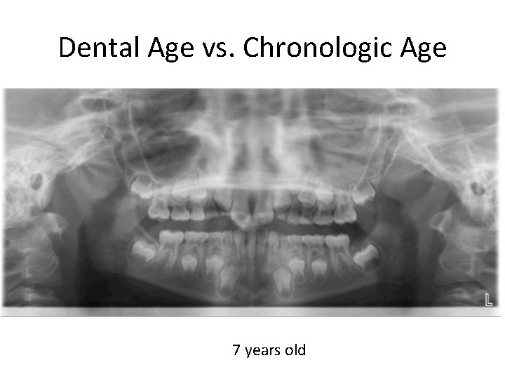 Dental Age vs. Chronologic Age 7 years old 