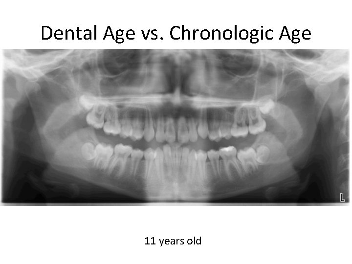 Dental Age vs. Chronologic Age 11 years old 