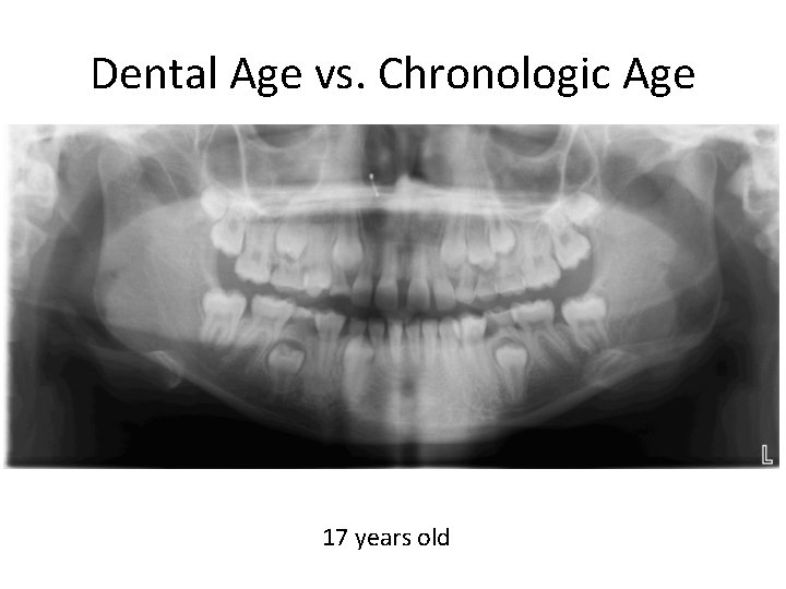 Dental Age vs. Chronologic Age 17 years old 
