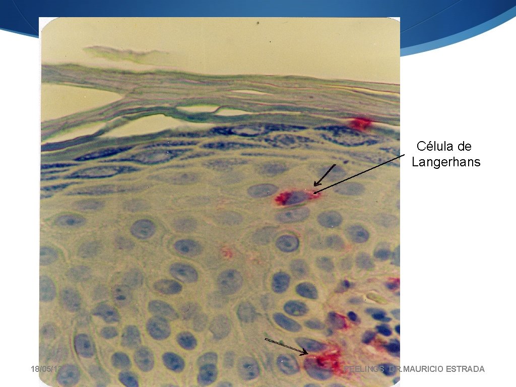 Célula de Langerhans 18/05/13 27 PEELINGS DR. MAURICIO ESTRADA 