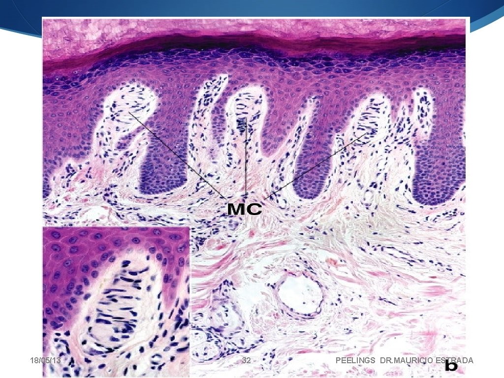 18/05/13 32 PEELINGS DR. MAURICIO ESTRADA 