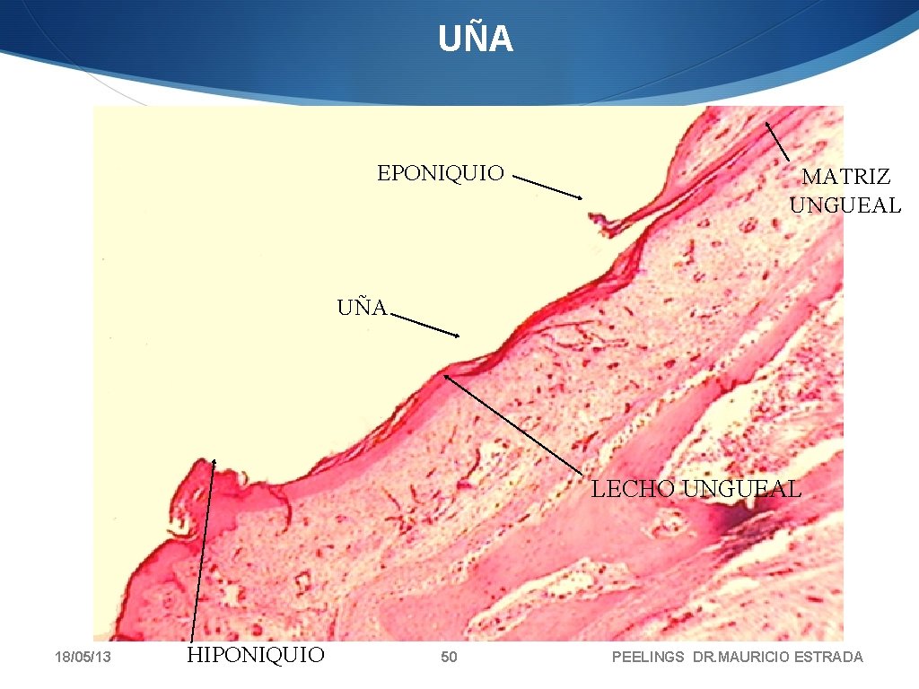 UÑA EPONIQUIO MATRIZ UNGUEAL UÑA LECHO UNGUEAL 18/05/13 HIPONIQUIO 50 PEELINGS DR. MAURICIO ESTRADA