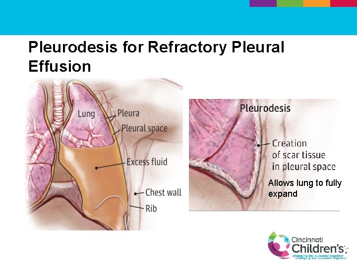 Pleurodesis for Refractory Pleural Effusion Allows lung to fully expand 