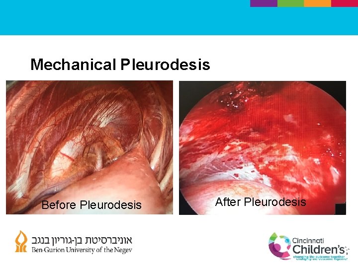 Mechanical Pleurodesis Before Pleurodesis After Pleurodesis 