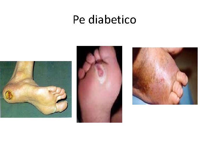 Pe diabetico 