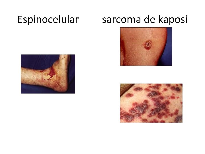 Espinocelular sarcoma de kaposi 