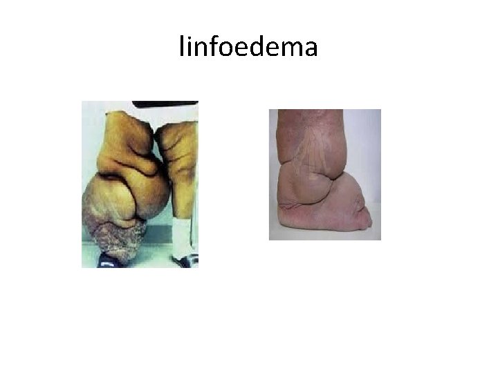 linfoedema 