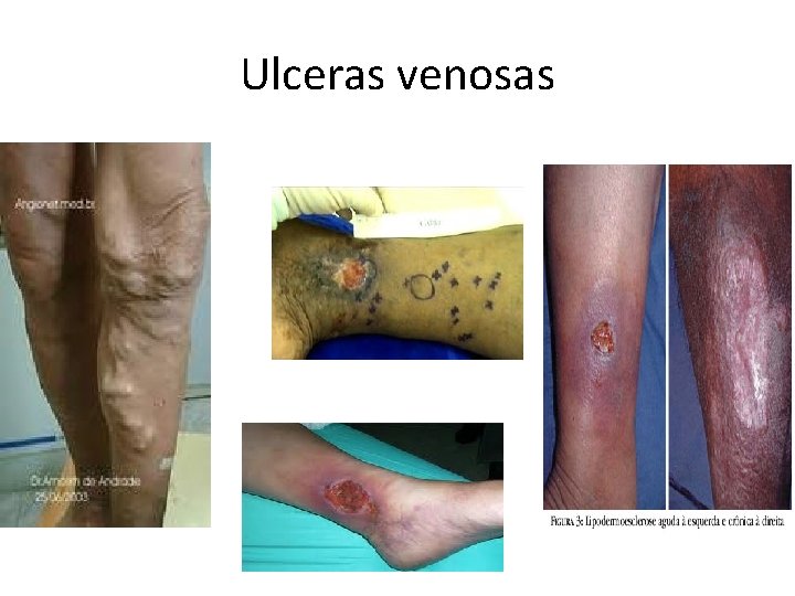 Ulceras venosas 