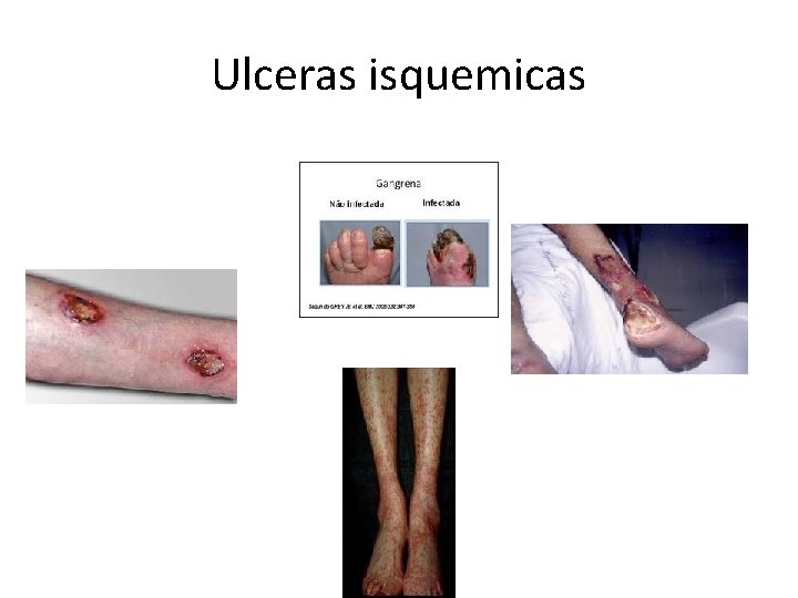 Ulceras isquemicas 
