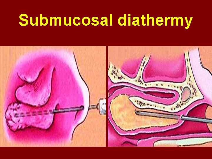Submucosal diathermy 