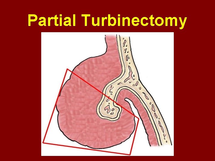 Partial Turbinectomy 