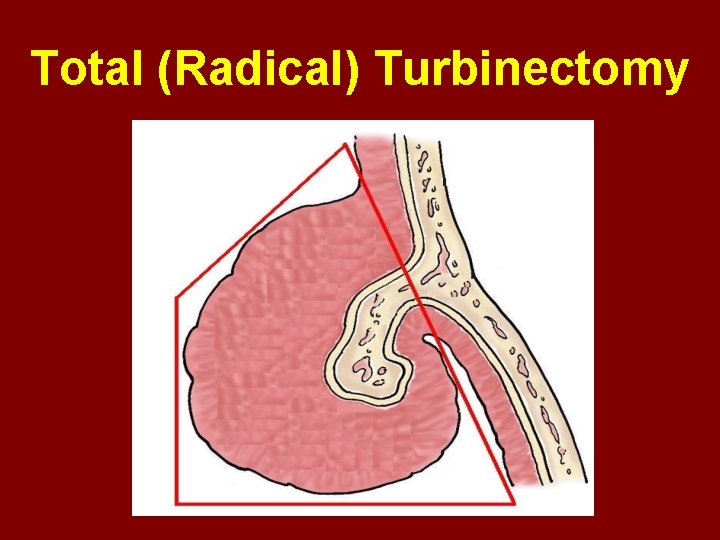 Total (Radical) Turbinectomy 