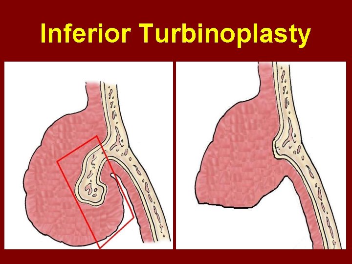 Inferior Turbinoplasty 