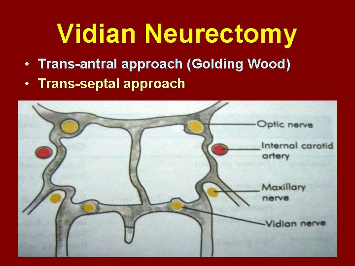 Vidian Neurectomy • Trans-antral approach (Golding Wood) • Trans-septal approach 