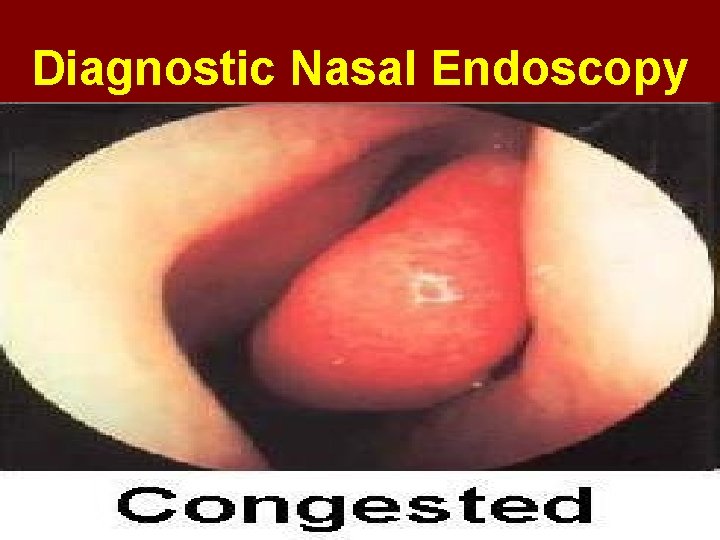 Diagnostic Nasal Endoscopy 