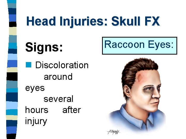 Head Injuries: Skull FX Signs: n Discoloration around eyes several hours after injury Raccoon