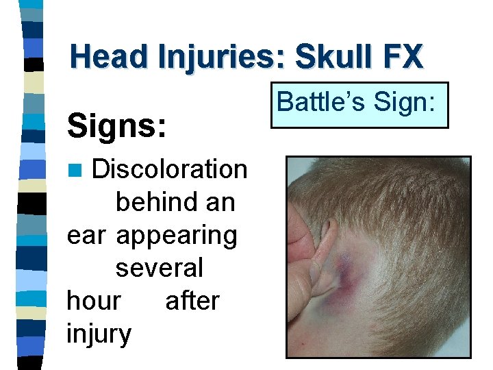 Head Injuries: Skull FX Signs: Discoloration behind an ear appearing several hour after injury